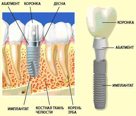implantology